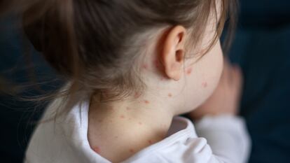 Una niña con brote de sarampión en el cuerpo.